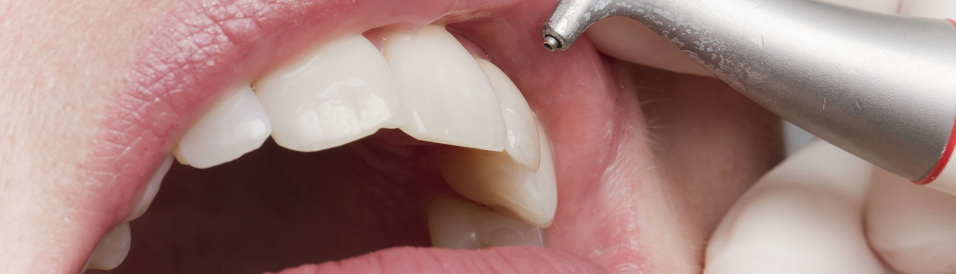Feste Zähne im Alter – mit Zahnimplantaten bei Dr. Höch
